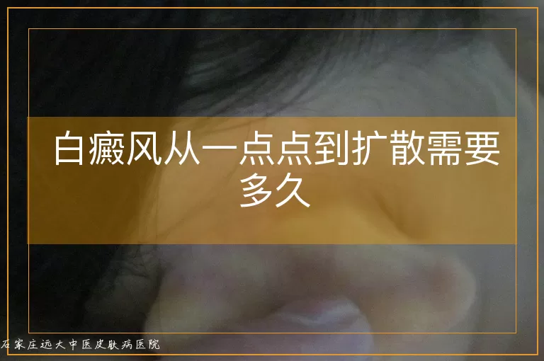 白癜风从一点点到扩散需要多久
