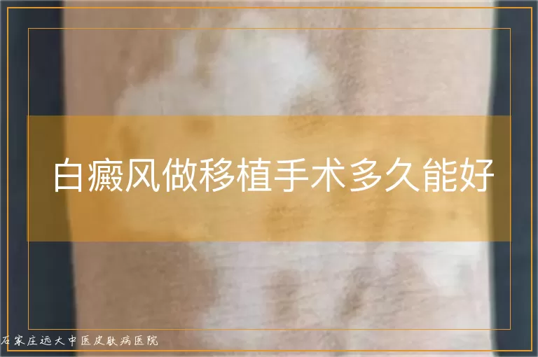 白癜风做移植手术多久能好