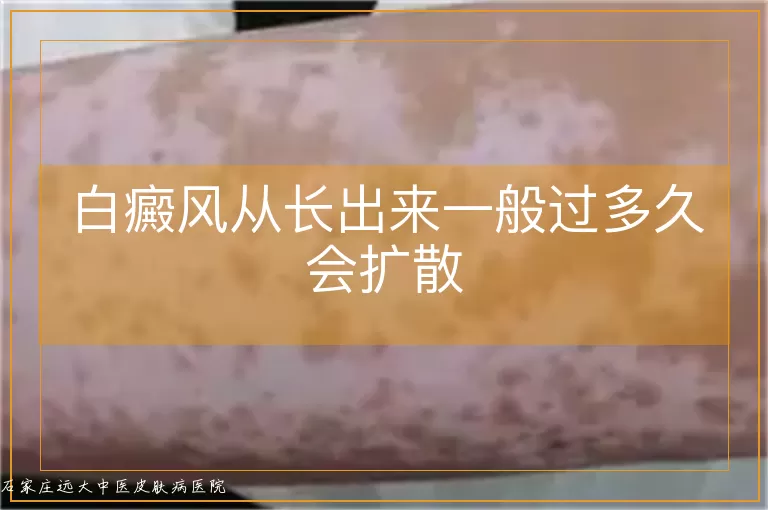 白癜风从长出来一般过多久会扩散