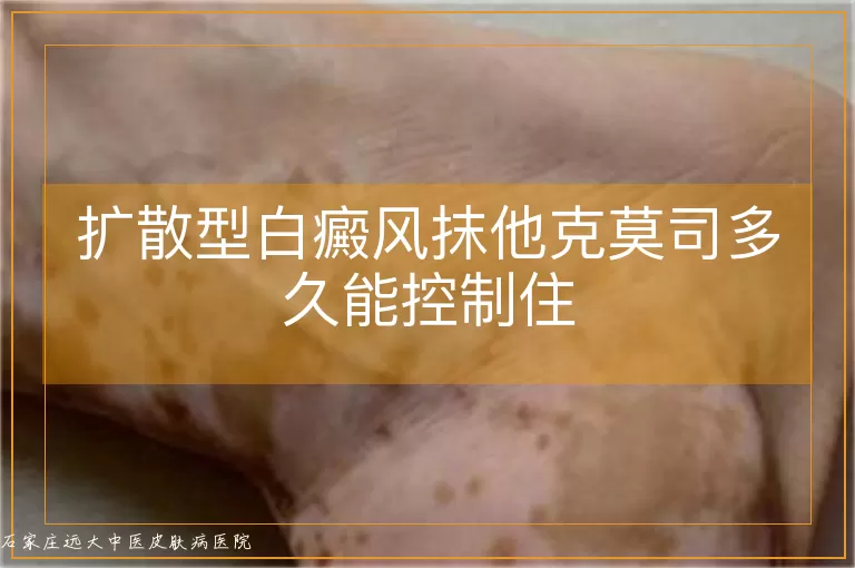 扩散型白癜风抹他克莫司多久能控制住