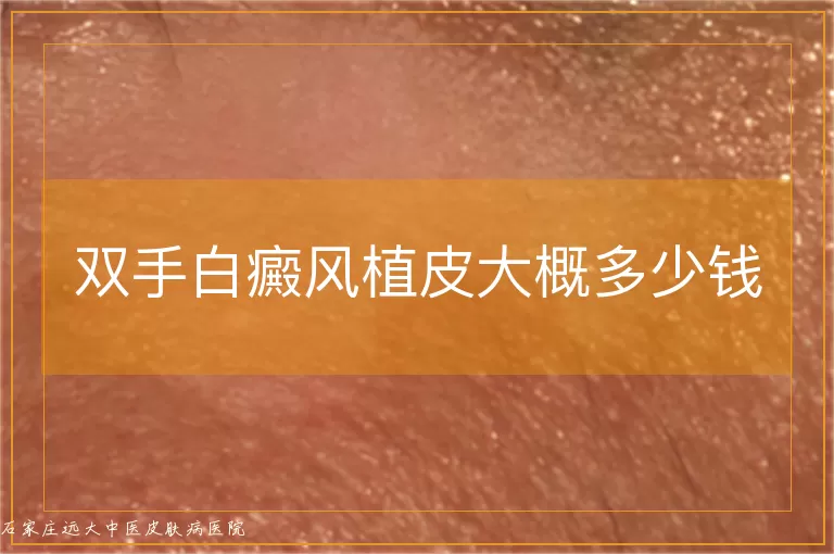 双手白癜风植皮大概多少钱