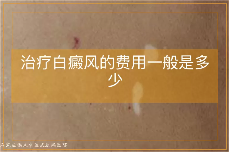 治疗白癜风的费用一般是多少