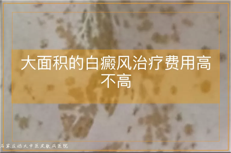 大面积的白癜风治疗费用高不高