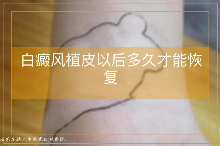白癜风植皮以后多久才能恢复