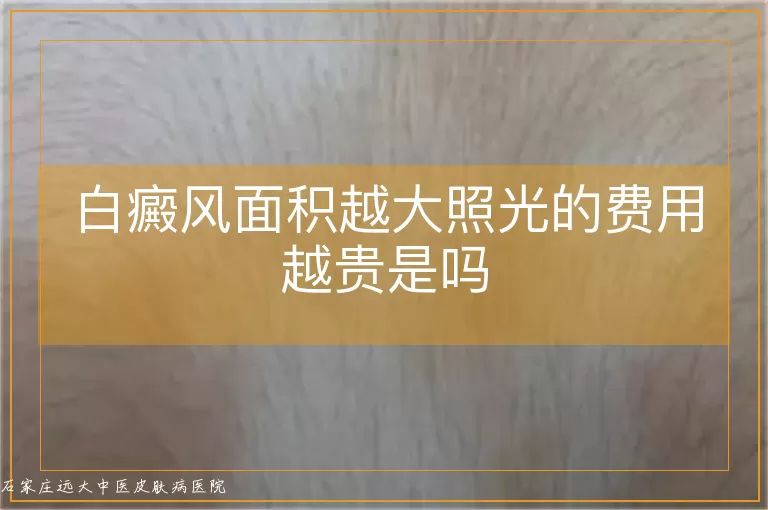白癜风面积越大照光的费用越贵是吗