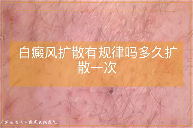 白癜风扩散有规律吗多久扩散一次