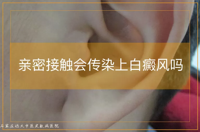 亲密接触会传染上白癜风吗