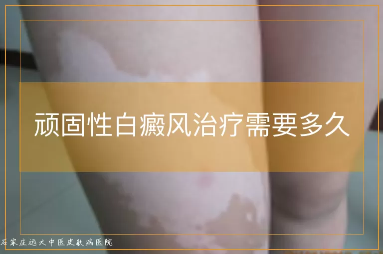 顽固性白癜风治疗需要多久