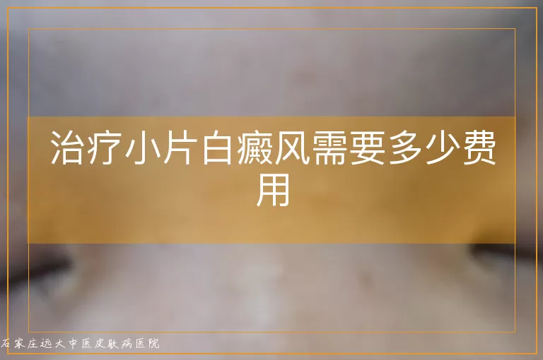 治疗小片白癜风需要多少费用