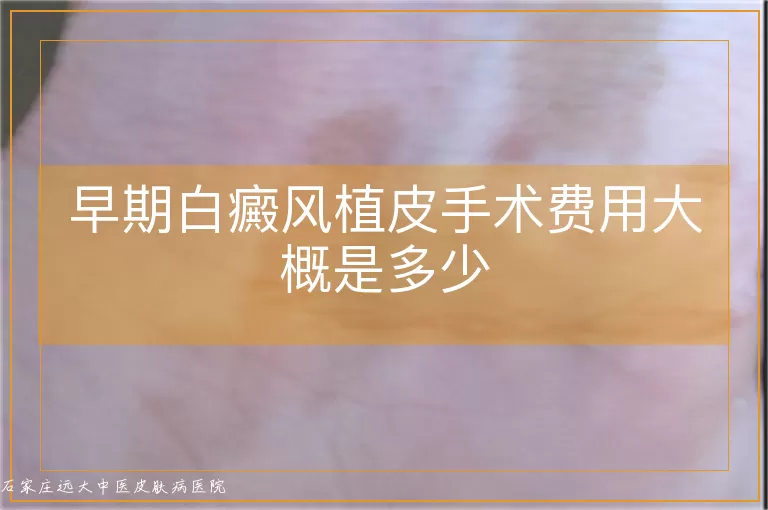 早期白癜风植皮手术费用大概是多少
