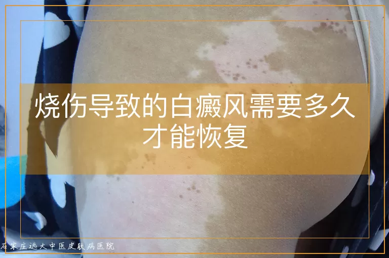 烧伤导致的白癜风需要多久才能恢复