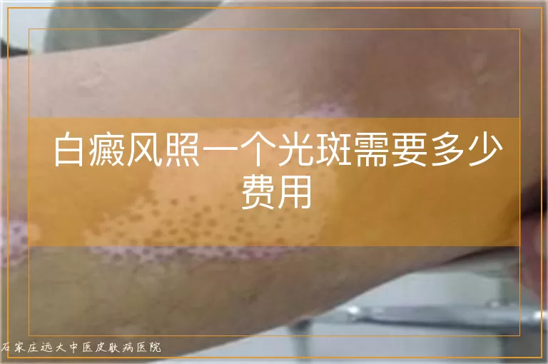 白癜风照一个光斑需要多少费用
