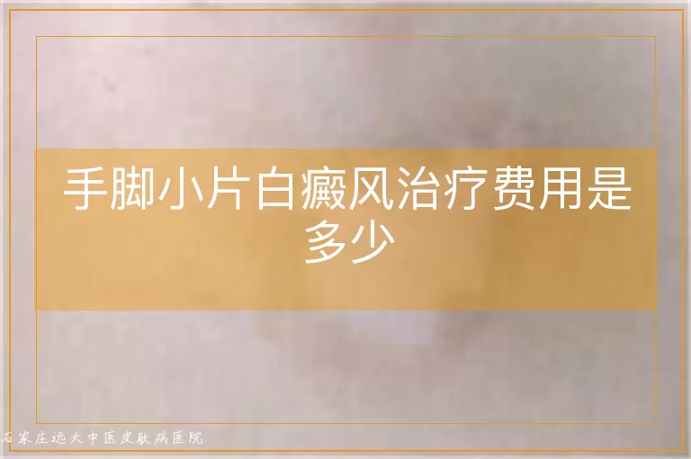 手脚小片白癜风治疗费用是多少