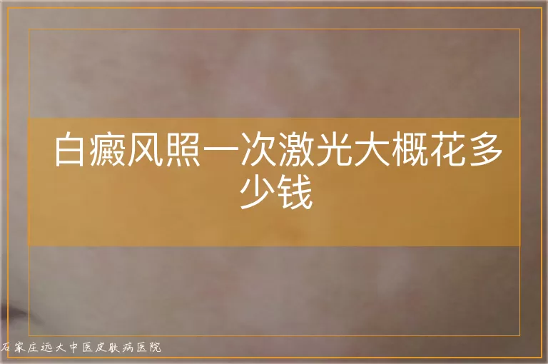 白癜风照一次激光大概花多少钱