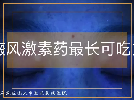 白癜风激素药最长可吃多久