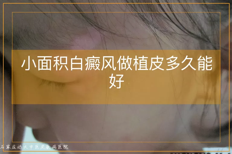 小面积白癜风做植皮多久能好