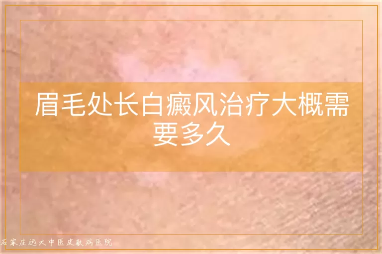 眉毛处长白癜风治疗大概需要多久