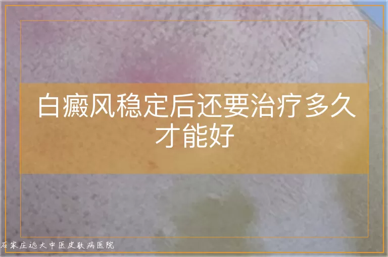 白癜风稳定后还要治疗多久才能好