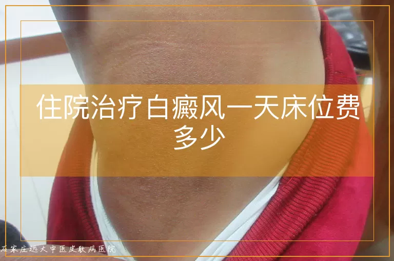 住院治疗白癜风一天床位费多少