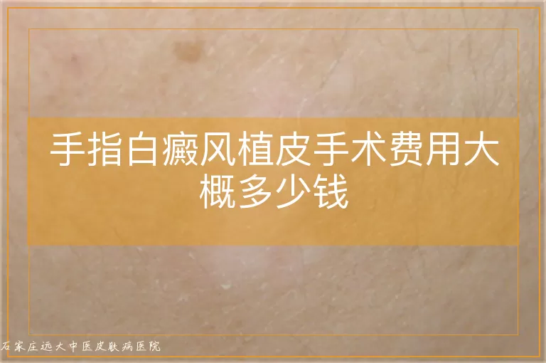 手指白癜风植皮手术费用大概多少钱