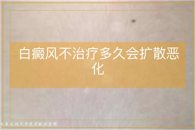 白癜风不治疗多久会扩散恶化