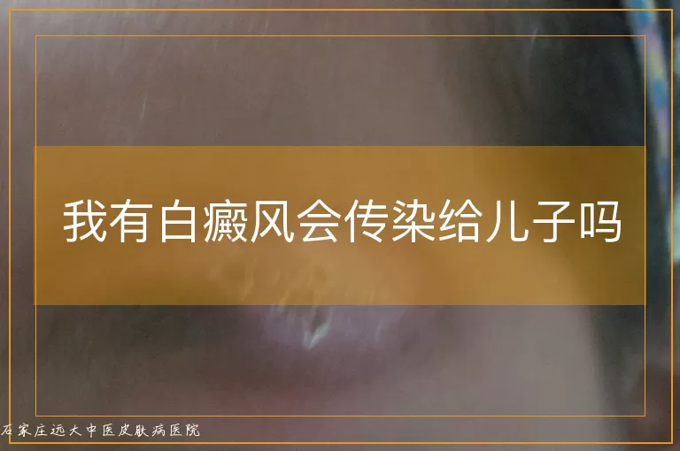 我有白癜风会传染给儿子吗