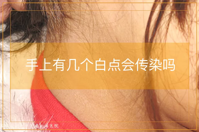 手上有几个白点会传染吗