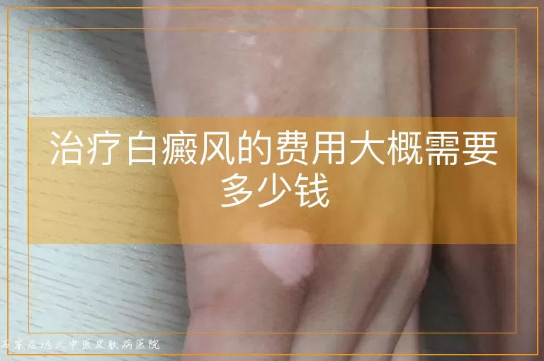 治疗白癜风的费用大概需要多少钱