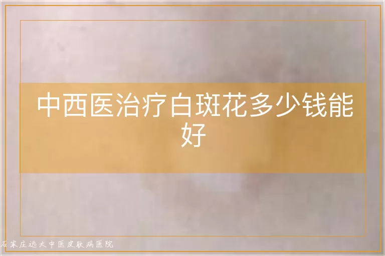 中西医治疗白斑花多少钱能好