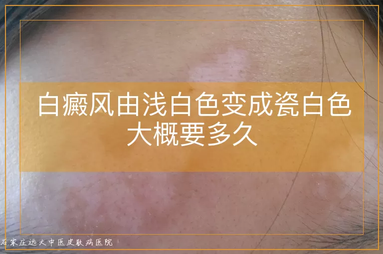 白癜风由浅白色变成瓷白色大概要多久