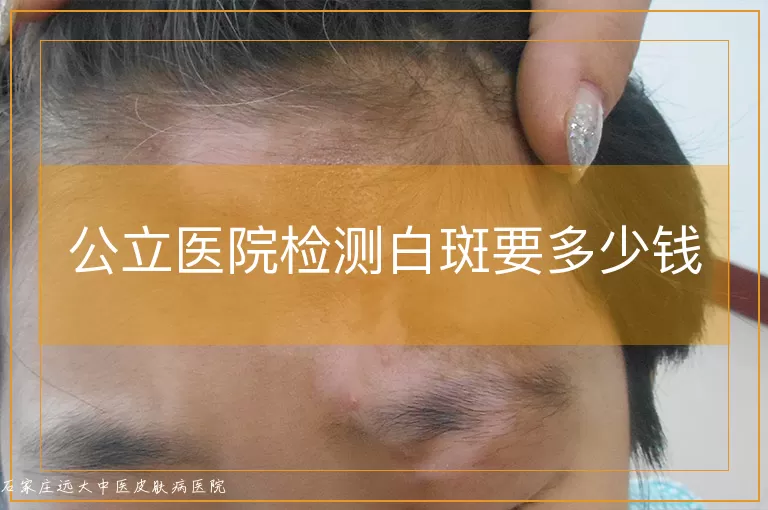 公立医院检测白斑要多少钱