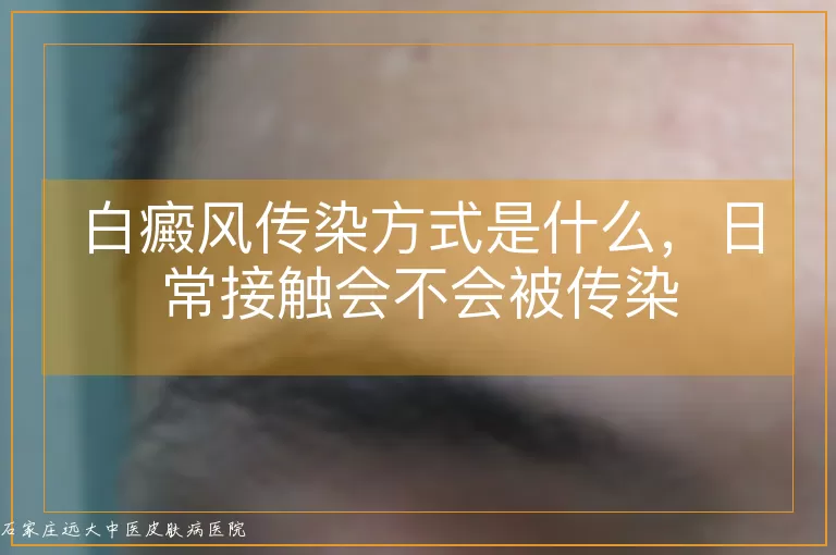 白癜风传染方式是什么，日常接触会不会被传染
