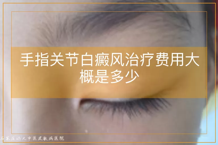 手指关节白癜风治疗费用大概是多少