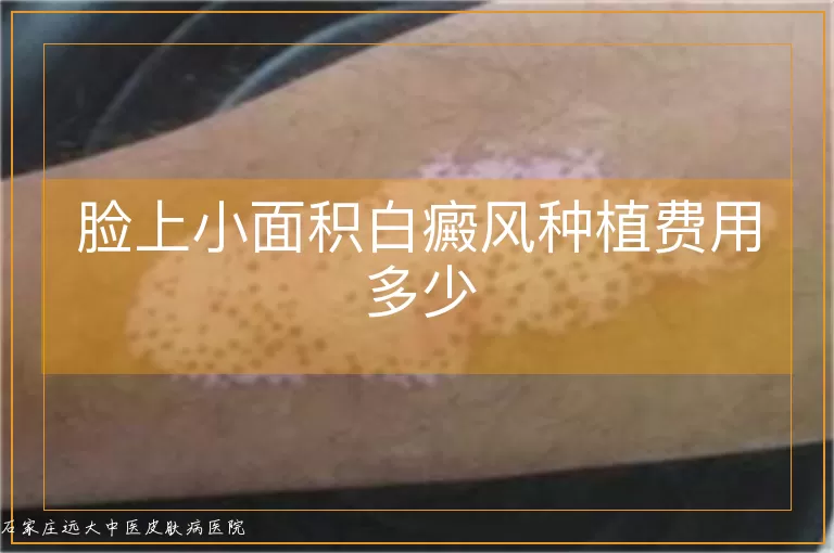 脸上小面积白癜风种植费用多少