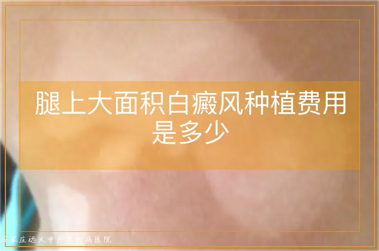 腿上大面积白癜风种植费用是多少