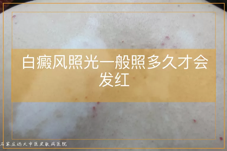 白癜风照光一般照多久才会发红