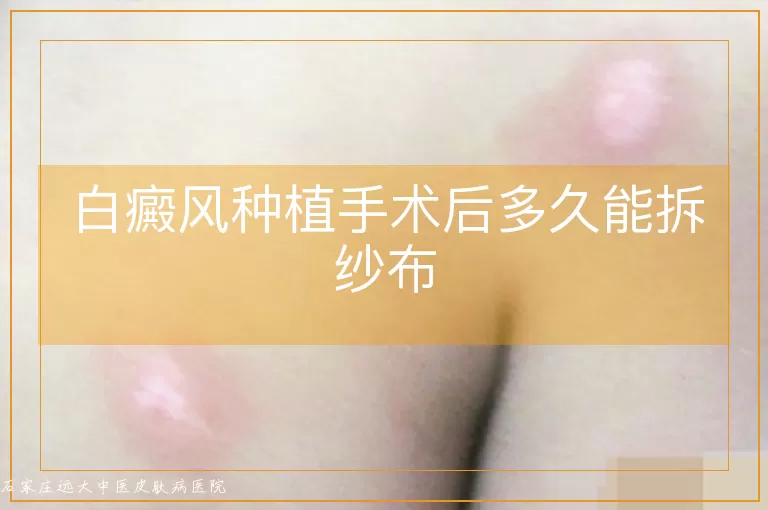 白癜风种植手术后多久能拆纱布