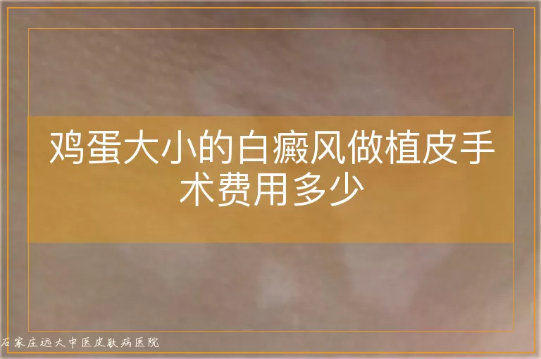 鸡蛋大小的白癜风做植皮手术费用多少