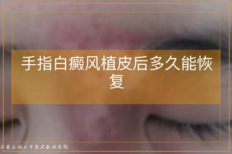 手指白癜风植皮后多久能恢复