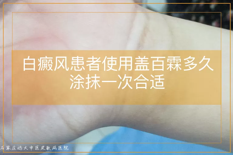 白癜风患者使用盖百霖多久涂抹一次合适