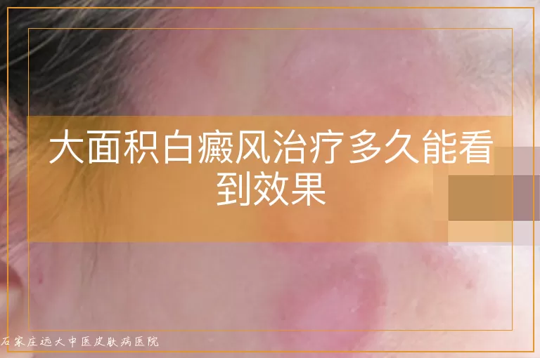 大面积白癜风治疗多久能看到效果