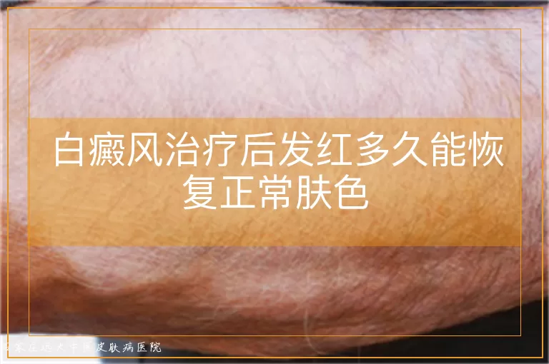 白癜风治疗后发红多久能恢复正常肤色