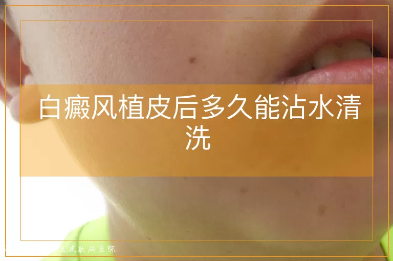白癜风植皮后多久能沾水清洗