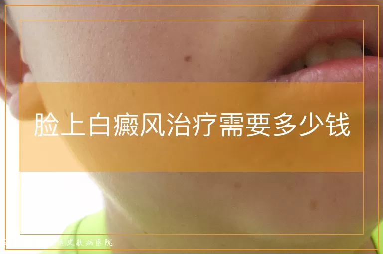 脸上白癜风治疗需要多少钱