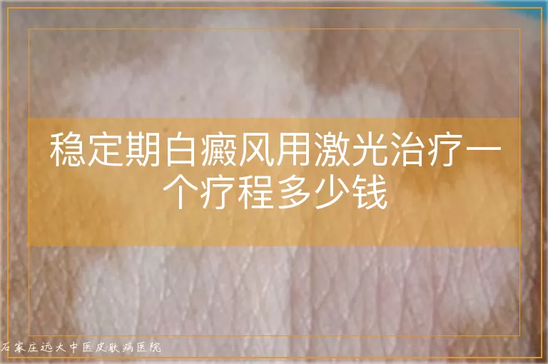 稳定期白癜风用激光治疗一个疗程多少钱