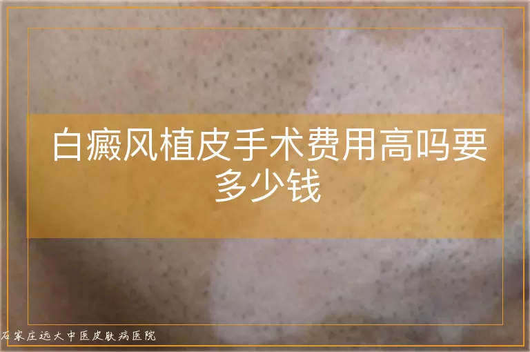 白癜风植皮手术费用高吗要多少钱