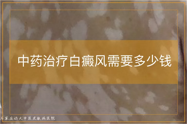 中药治疗白癜风需要多少钱