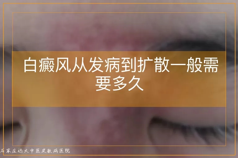 白癜风从发病到扩散一般需要多久