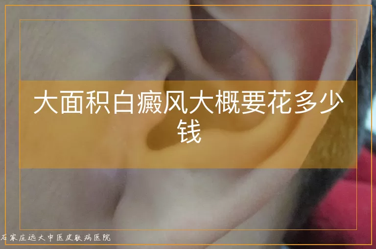 大面积白癜风大概要花多少钱