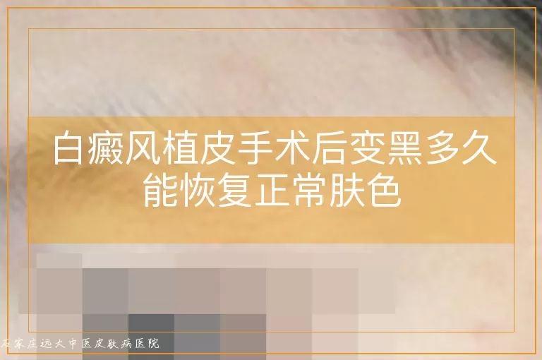 白癜风植皮手术后变黑多久能恢复正常肤色